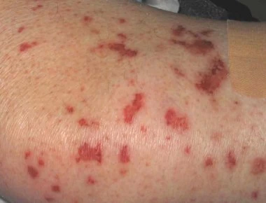 Σταφυλόκοκκος: Όλα τα συμπτώματα για να ξέρετε αν έχετε μολυνθεί (φωτο)